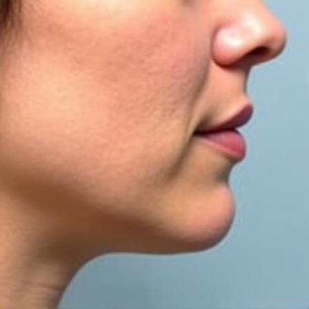 Before: Jawline before contouring